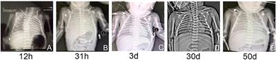 A Term Neonatal Case With Lethal Respiratory Failure Associated With a Novel Homozygous Mutation in ABCA3 Gene